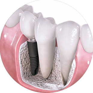 Зубные Имплантаты